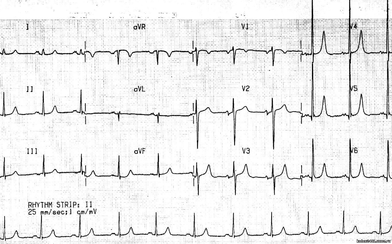 ECG gipertrophy LA LV